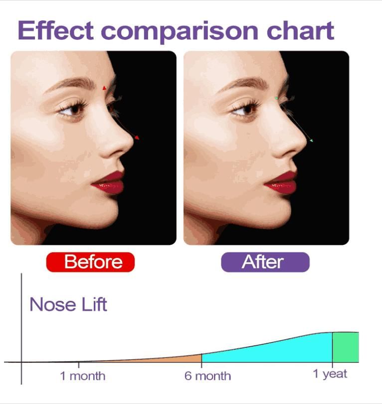 Nose Up Clip High Lifting Clipper Correction For Shaping Nose Tool 0c2542-3a