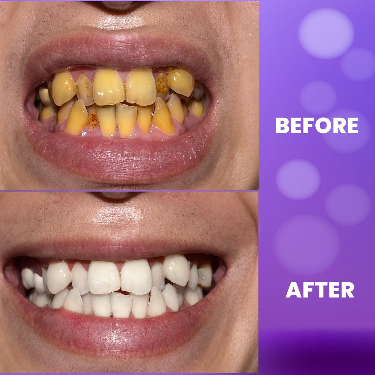 Purple Teeth Whitening Gel 0c2542-3a