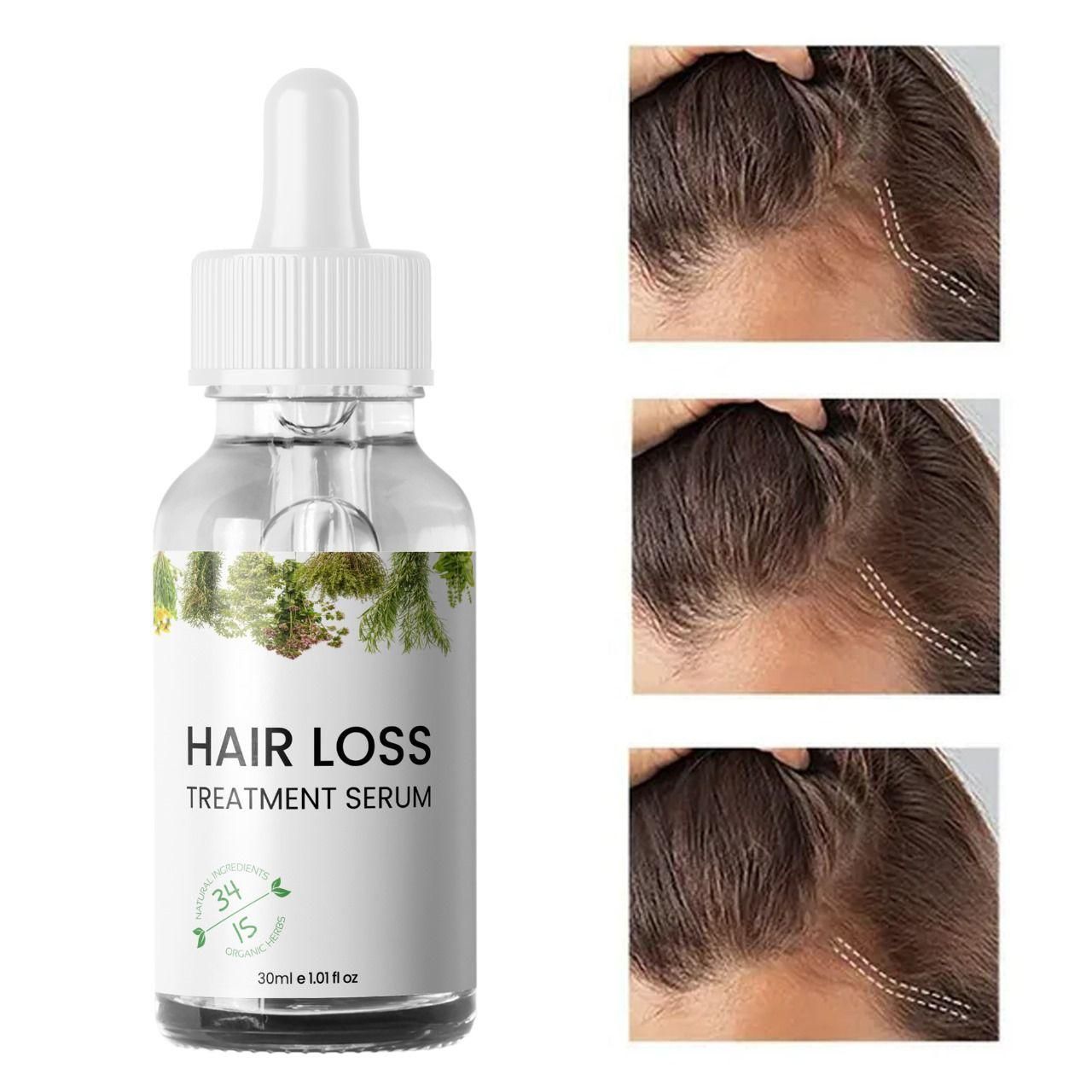 Hair Loss Treatment Serum 30Ml (Pack Of 2) 0c2542-3a